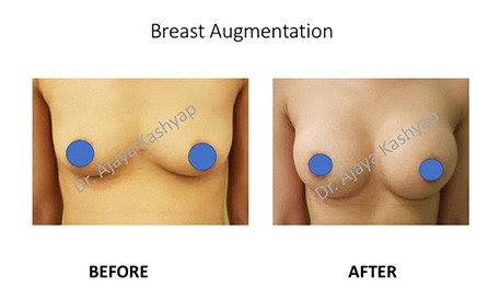 breast augmentation in Delhi