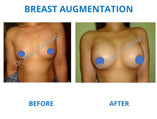 breast augmentation surgery india