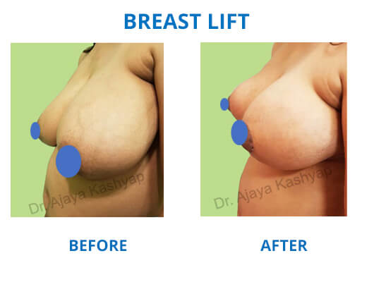 breast lift surgery cost