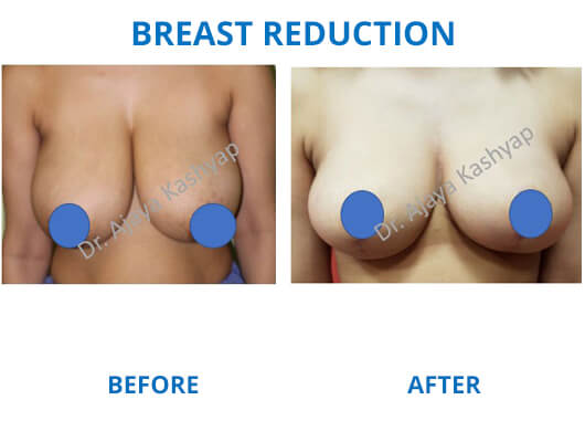 breast reduction surgeon