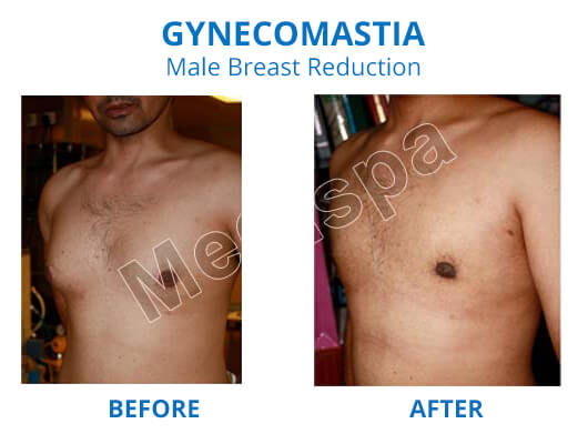 gynecomastia before and after