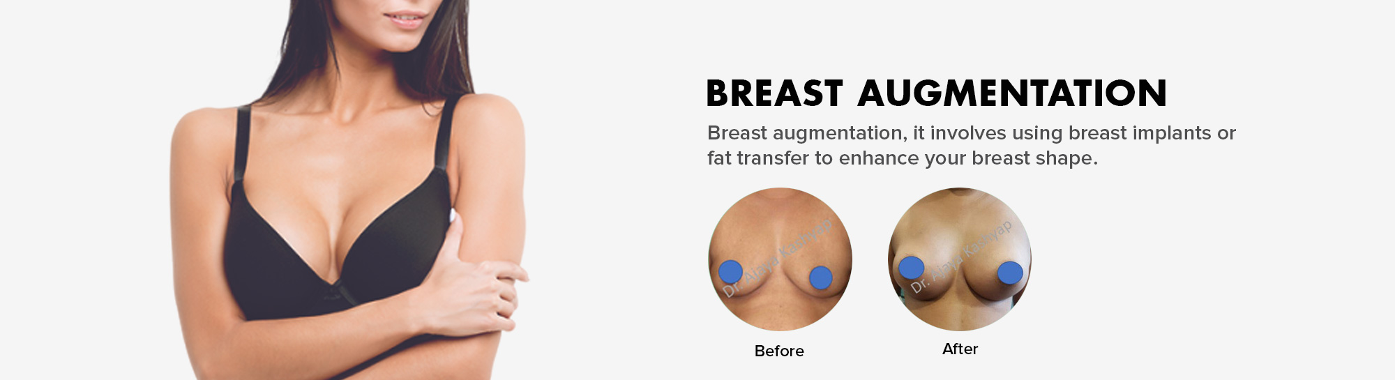 breast augmentation surgery in Delhi