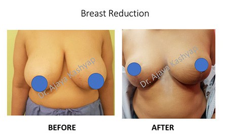 breast reduction in Delhi