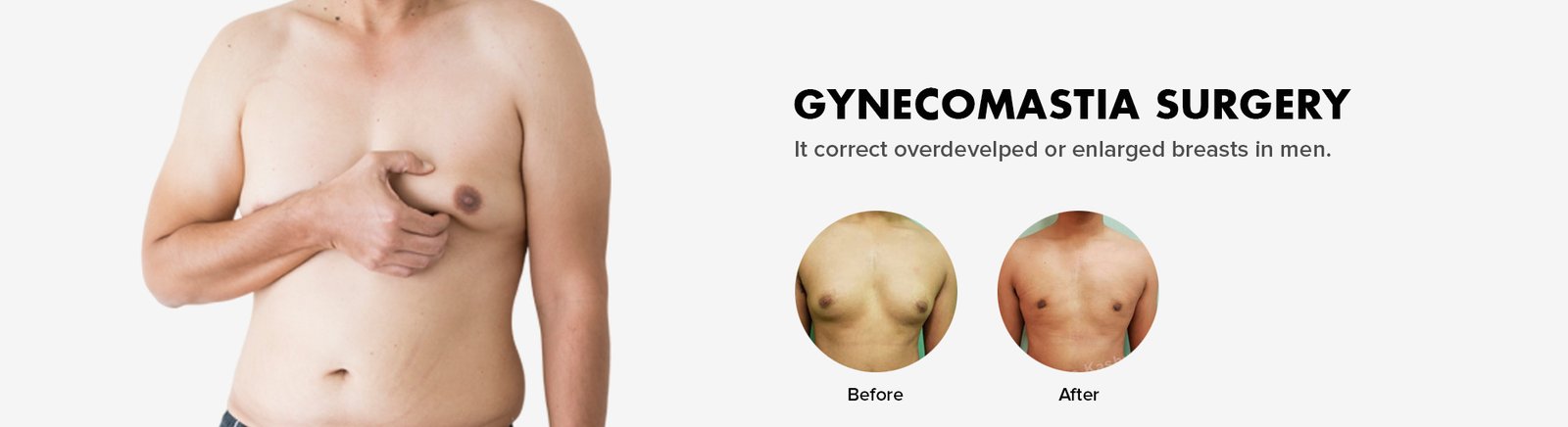 Gynecomastia surgery in Delhi