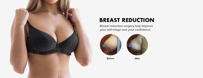 breast reduction surgery in Delhi