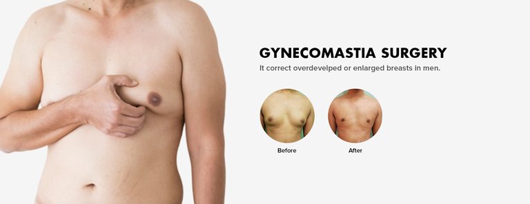 Gynecomastia surgery in Delhi